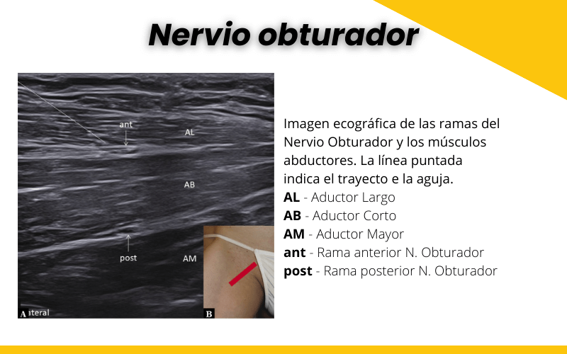 Nervio obturador y ecografia tempo formacion.png